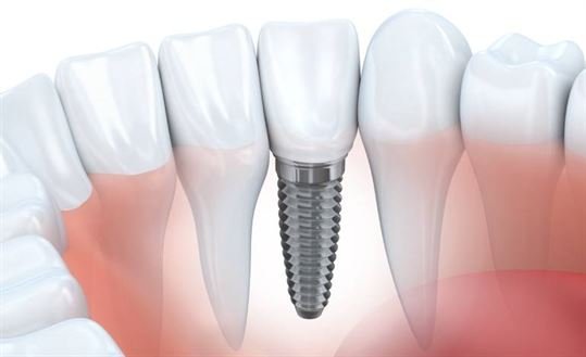 Dental Implant
