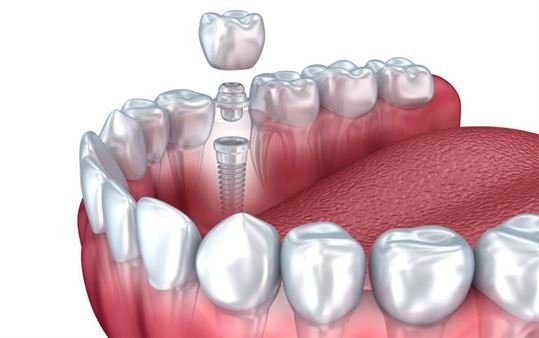 Dental Implant