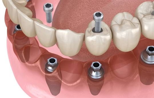 Dental Implant