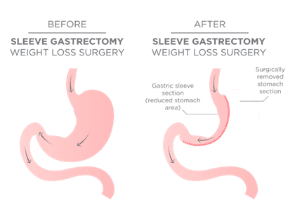 Gastric