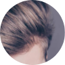 Hair Transplant